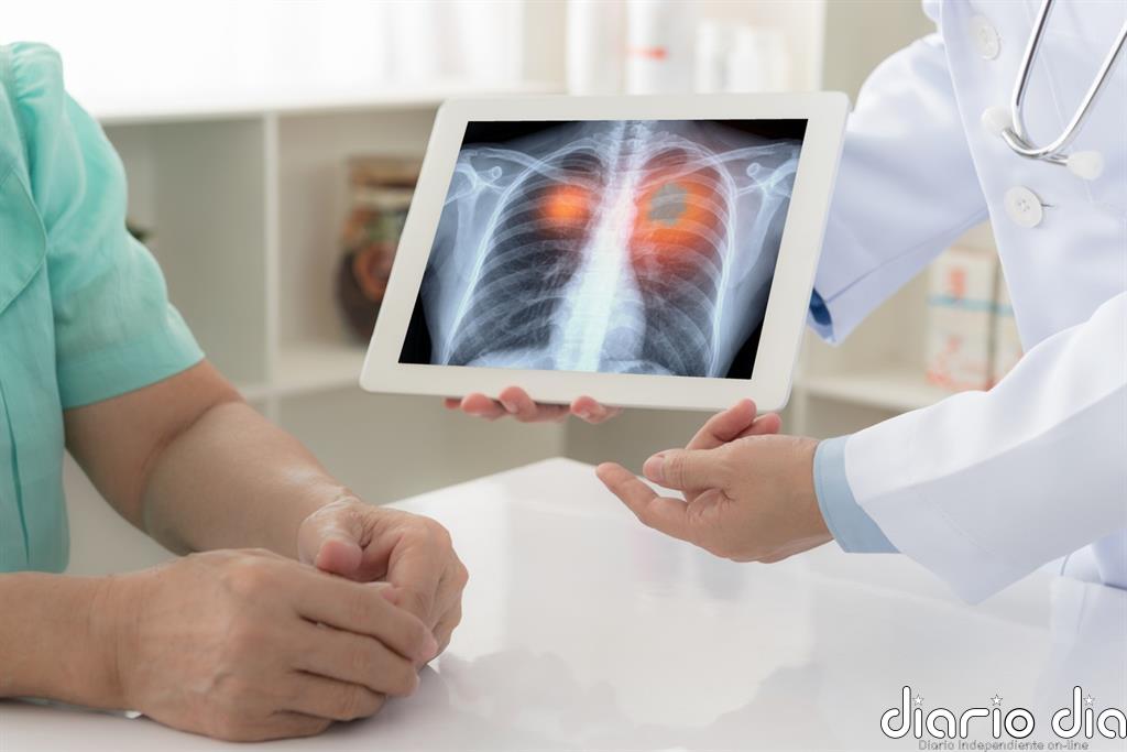 Pacientes con cáncer de pulmón y tumores hematológicos, los de peor pronóstico ante la COVID-19