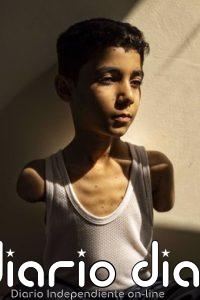 La imagen de Mahmoud, un niño mutilado de Gaza, foto del año del World Press Photo
