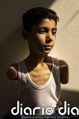 La imagen de Mahmoud, un niño mutilado de Gaza, foto del año del World Press Photo