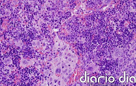 Linfoma folicular: un tratamiento clásico logra que muchos pacientes puedan considerarse curados por primera vez