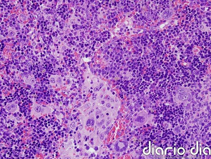 Linfoma folicular: un tratamiento clásico logra que muchos pacientes puedan considerarse curados por primera vez