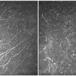 Un estudio clínico liderado por el IN revela que la aniridia provoca una pérdida progresiva de sensibilidad en la córnea