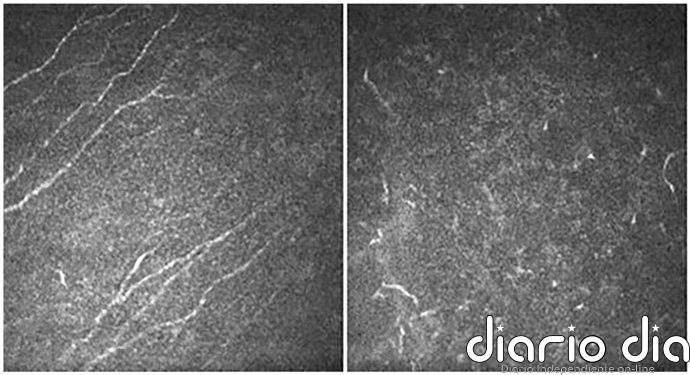 Un estudio clínico liderado por el IN revela que la aniridia provoca una pérdida progresiva de sensibilidad en la córnea