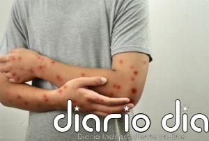 El SCS da por cerrado el brote de sarampión en La Palma con 56 casos