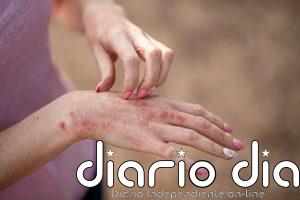 Estrés y dermatitis atópica: una vía neuronal conecta el cerebro con la inflamación de la piel