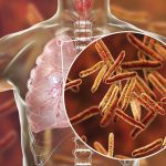 Europa no detecta uno de cada cinco casos de tuberculosis