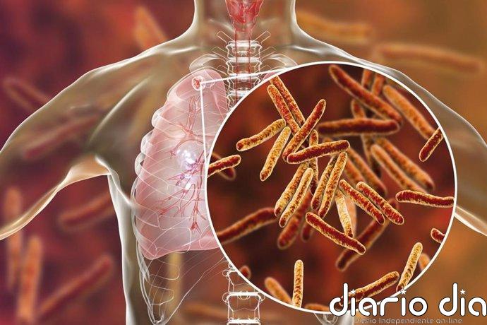 Europa no detecta uno de cada cinco casos de tuberculosis