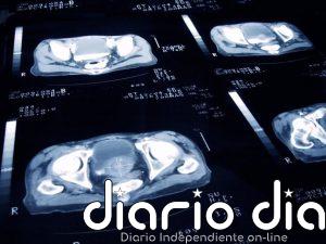 La terapia con PSMA retrasa la terapia hormonal en el cáncer de próstata