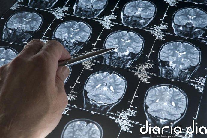 Nuevo fármaco experimental apunta a una diana clave para frenar las malformaciones cavernosas cerebrales