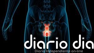 El cáncer de testículo aumenta en hombres jóvenes, según el Instituto de Cirugía Urológica Avanzada