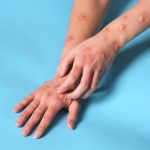 La ruta de contagio del mpox podría cambiar con el tiempo: del contacto sexual al entorno familiar