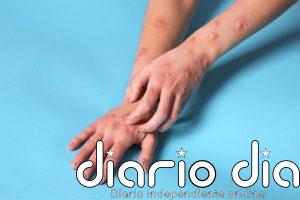 La ruta de contagio del mpox podría cambiar con el tiempo: del contacto sexual al entorno familiar