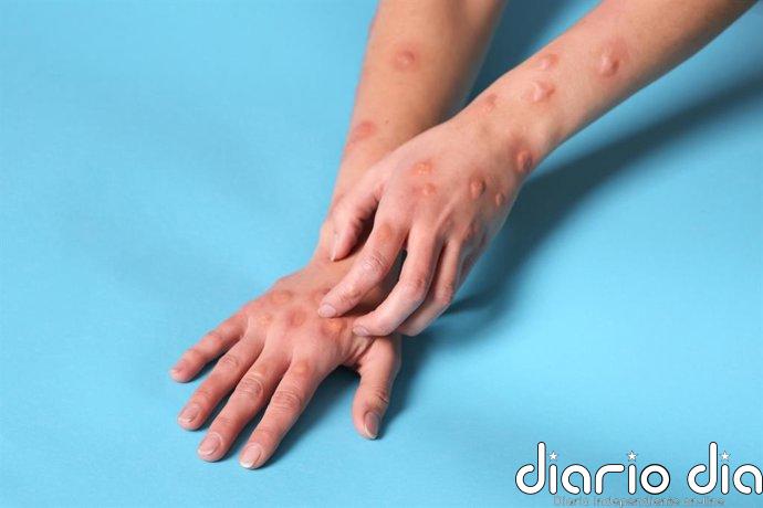 La ruta de contagio del mpox podría cambiar con el tiempo: del contacto sexual al entorno familiar