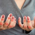 Las enfermedades autoinmunes podrían tener un origen genético oculto en las células inmunitarias