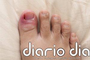 Podóloga asegura que la infiltración local de corticoides puede reducir la inflamación de la uña encarnada