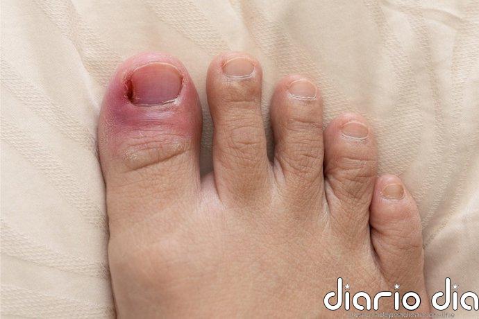 Podóloga asegura que la infiltración local de corticoides puede reducir la inflamación de la uña encarnada
