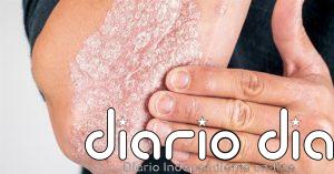 Por qué la psoriasis siempre vuelve al mismo sitio: el descubrimiento sobre la 'memoria' de la piel