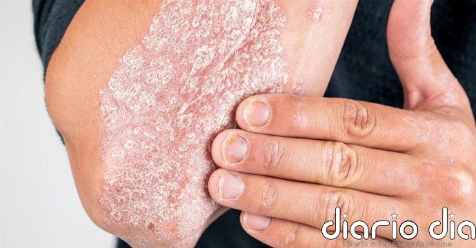Por qué la psoriasis siempre vuelve al mismo sitio: el descubrimiento sobre la 'memoria' de la piel