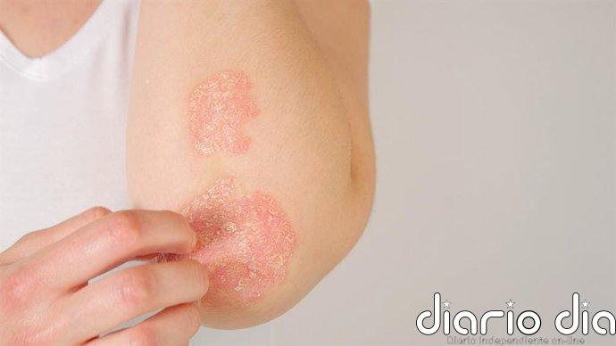 Psoriasis y enfermedades de la piel: descubren el fallo oculto en tu piel que podría empeorarlas