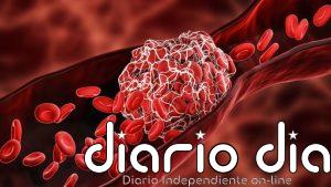 Un nuevo stent podría acabar con el dolor crónico de piernas tras un trombo y devolver la movilidad a miles de pacientes