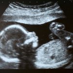Cuando la presión arterial de la madre condiciona el corazón del hijo