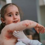 De curas diarias de 4 horas a una nueva esperanza: 'Vyjuvek', el avance que revoluciona la piel de mariposa