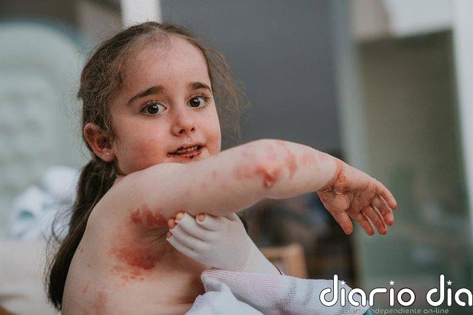 De curas diarias de 4 horas a una nueva esperanza: 'Vyjuvek', el avance que revoluciona la piel de mariposa