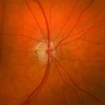 Descubren un 'equipo de limpieza' en el ojo que podría ayudar a prevenir la ceguera