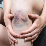 SEMERGEN pide reforzar la detección precoz del síndrome de Ehlers-Danlos en AP para evitar retrasos diagnósticos