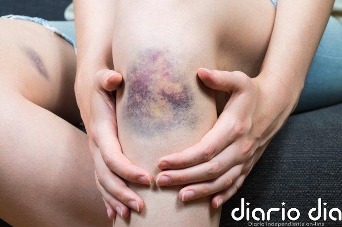 SEMERGEN pide reforzar la detección precoz del síndrome de Ehlers-Danlos en AP para evitar retrasos diagnósticos
