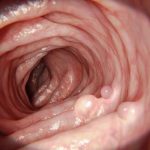 Tu pólipo ya no está, pero el riesgo de cáncer de colon sigue: científicos apuntan al microbioma y esta es la solución