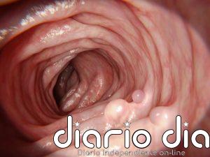 Tu pólipo ya no está, pero el riesgo de cáncer de colon sigue: científicos apuntan al microbioma y esta es la solución