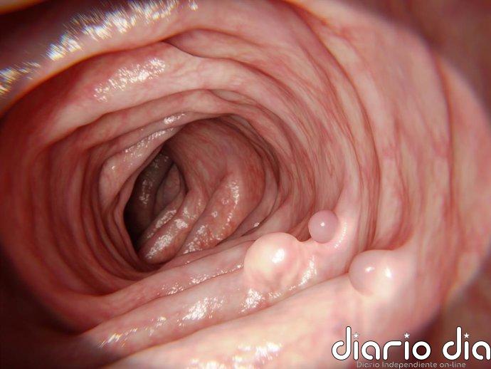 Tu pólipo ya no está, pero el riesgo de cáncer de colon sigue: científicos apuntan al microbioma y esta es la solución