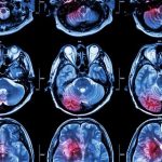 Un estudio pone el foco en la testosterona y su posible papel en el cáncer cerebral en hombres