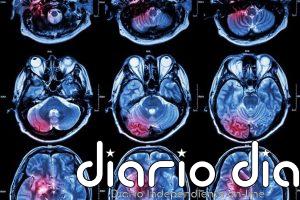 Un estudio pone el foco en la testosterona y su posible papel en el cáncer cerebral en hombres