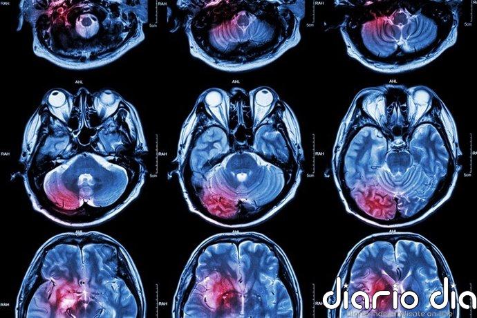 Un estudio pone el foco en la testosterona y su posible papel en el cáncer cerebral en hombres