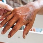 Colombia debe abordar la discriminación a pacientes de lepra