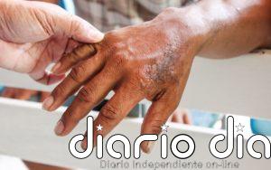 Colombia debe abordar la discriminación a pacientes de lepra