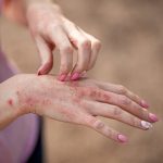 Detallan cómo la dermatitis atópica condiciona la trayectoria educativa y laboral