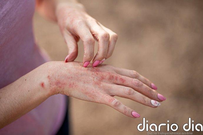 Detallan cómo la dermatitis atópica condiciona la trayectoria educativa y laboral
