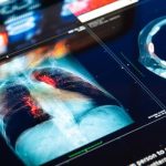 Investigadores hallan cómo activar células asesinas contra el cáncer de pulmón