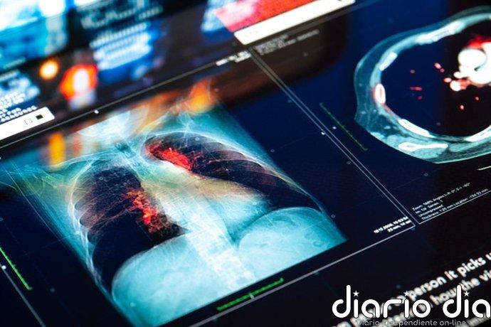 Investigadores hallan cómo activar células asesinas contra el cáncer de pulmón