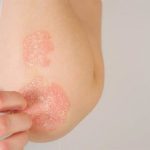 Ni más dosis ni más pinchazos: el hallazgo que puede cambiar el tratamiento de la psoriasis