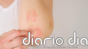 Ni más dosis ni más pinchazos: el hallazgo que puede cambiar el tratamiento de la psoriasis