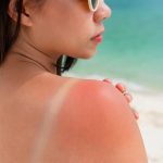 Reacciones cutáneas al sol: cuáles son, cómo identificarlas y cuándo preocuparse
