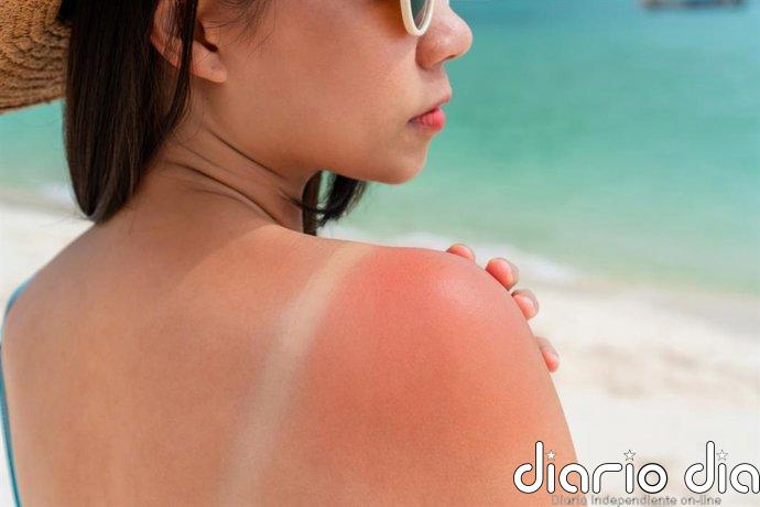 Reacciones cutáneas al sol: cuáles son, cómo identificarlas y cuándo preocuparse