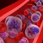 Cambian los criterios para identificar a los pacientes con mieloma múltiple de peor pronóstico