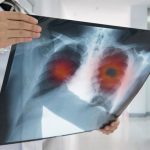 El ejército "oculto" de células inmunitarias en los pulmones contra las infecciones virales, bacterianas y fúngicas