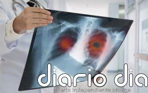 El ejército "oculto" de células inmunitarias en los pulmones contra las infecciones virales, bacterianas y fúngicas