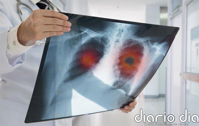El ejército "oculto" de células inmunitarias en los pulmones contra las infecciones virales, bacterianas y fúngicas